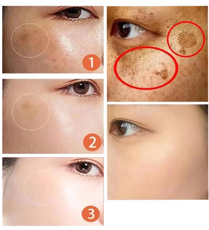 Velour - para manchas oscuras e hiperpigmentación